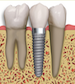 Dental Implants Crown Mount Vista Family Dental