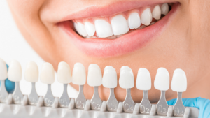 Teeth Whitening Scale