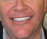 Dental Implant Services Salmon Creek Dentist - Vancouver WA Dentist - Mount Vista Dental